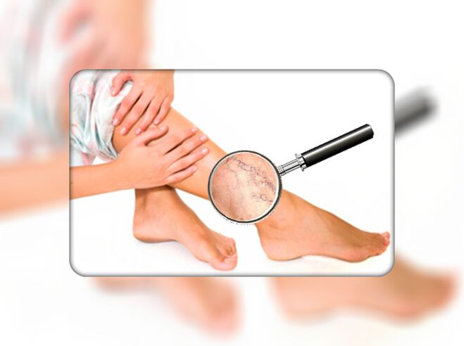 Varices