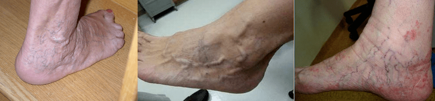 Varicosis de la pierna
